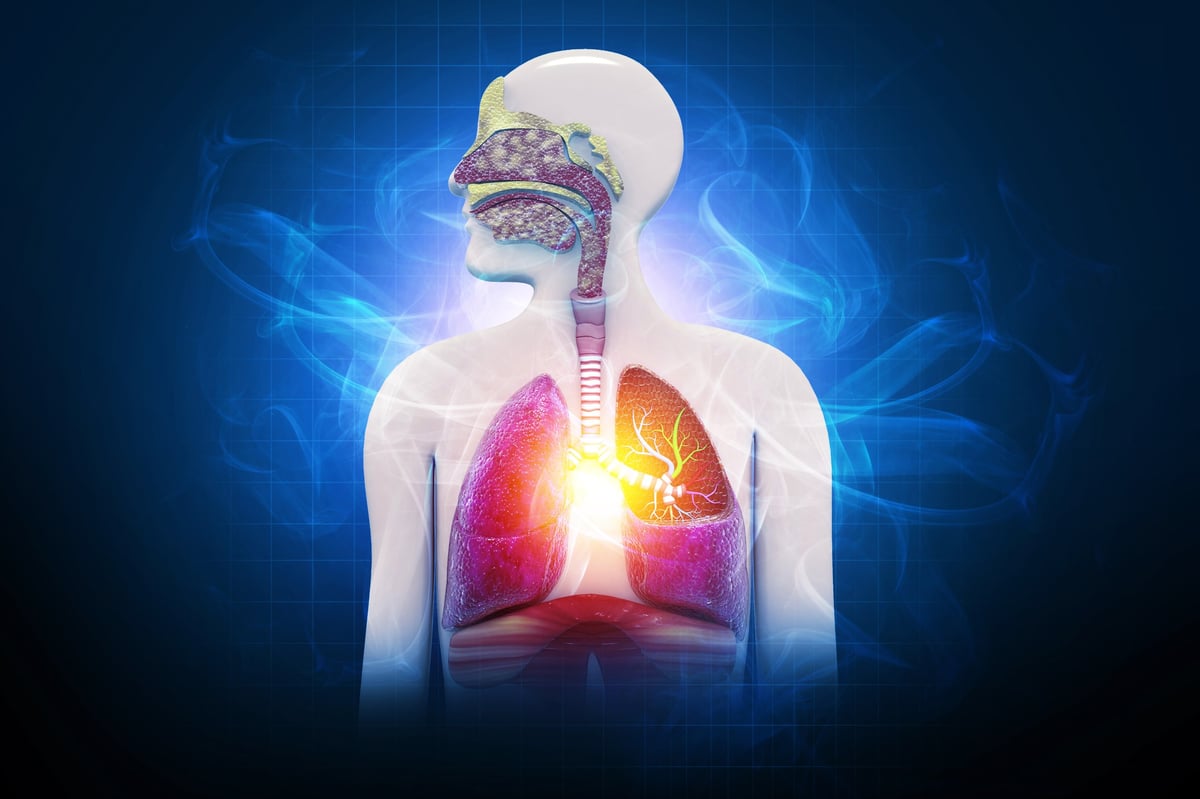 Ilustración de enfermedad pulmonar obstructiva crónica.